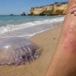 Atenção se vai à praia: saiba o que fazer se tocar numa alforreca e que erros deve evitar