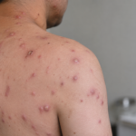 Já estão confirmados quase 300 casos: infeções por este vírus estão a aumentar em Portugal