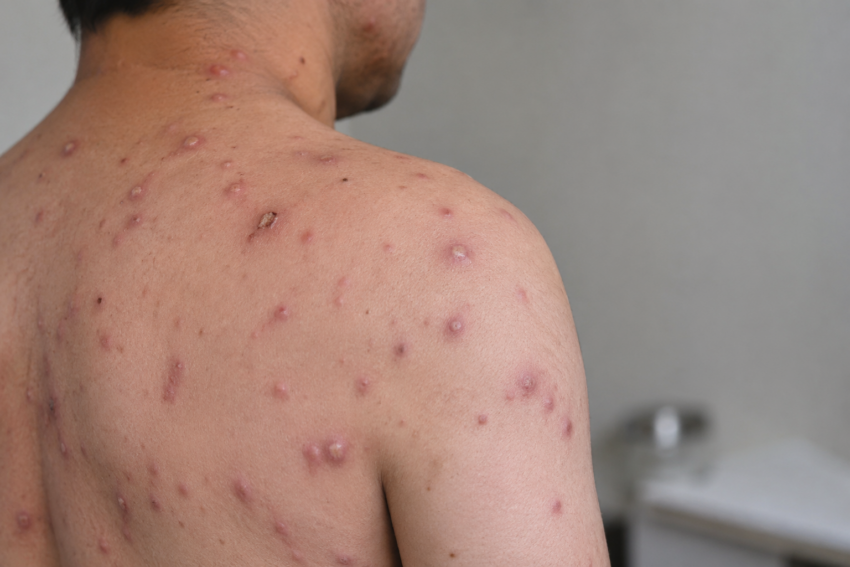 Pessoa infetada com mpox